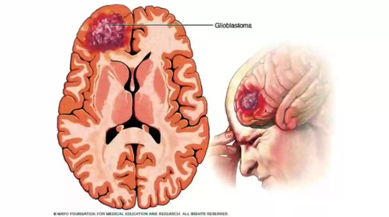  تعرف على علامات ورم المخ السرطاني من تجربة أحد المرضي